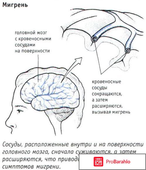 Мигрень симптомы и лечение 