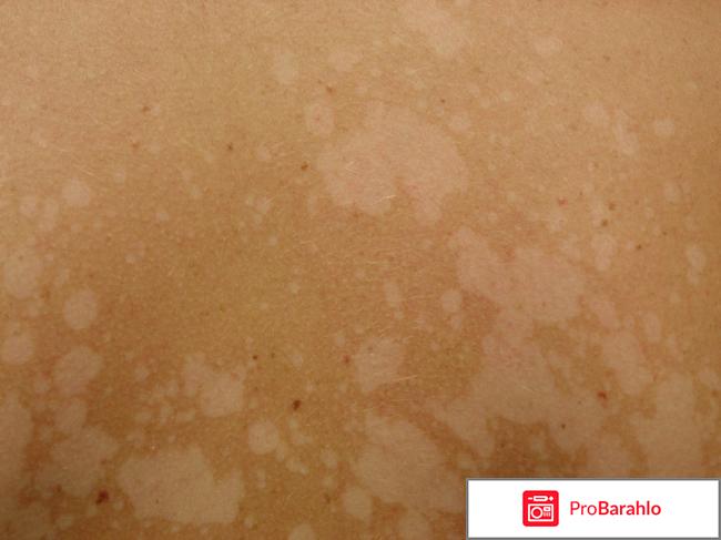 На спине появились белые пятна что это и как лечить отрицательные отзывы