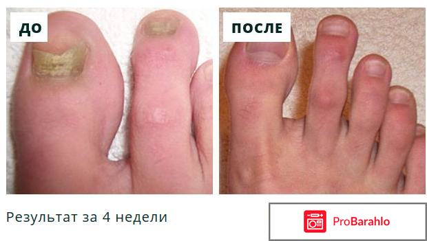 Сангридок спрей от грибка - развод или нет? фото