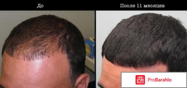 Миноксидил 5 