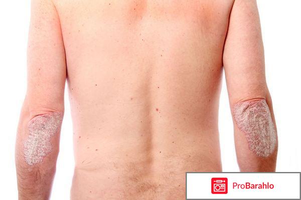 PsoriStop ( Псори Стоп ) - циничный развод-лохотрон на больных псориазом 
