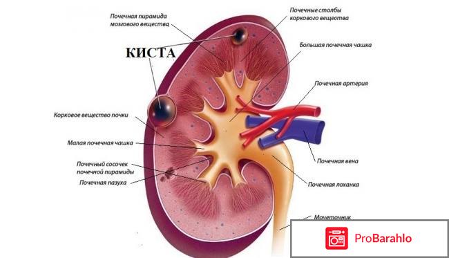 Киста почки лечение 