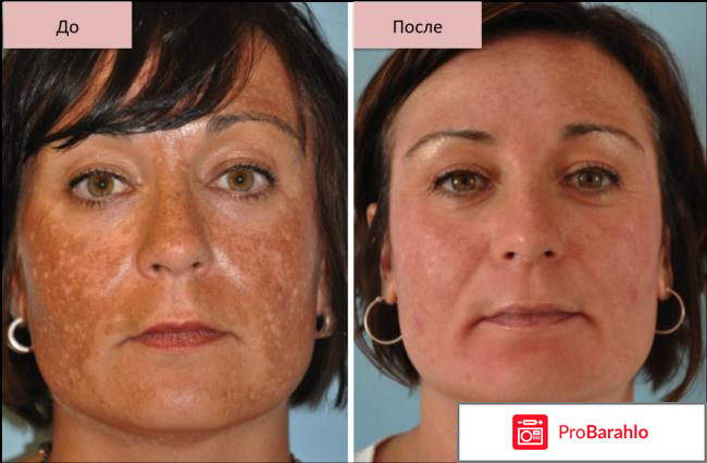 Miracle Glow — натуральная маска от пигментации реальные отзывы