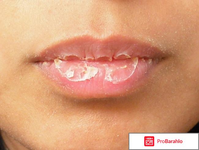 Герпферон таблетки инструкция по применению цена отзывы реальные отзывы