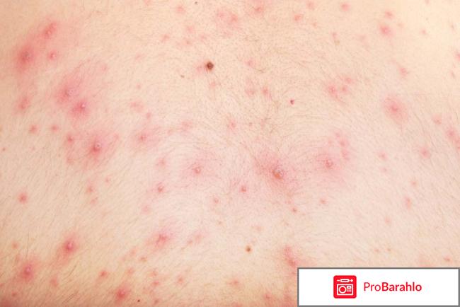 Артропант крем отзывы отрицательные отрицательные отзывы