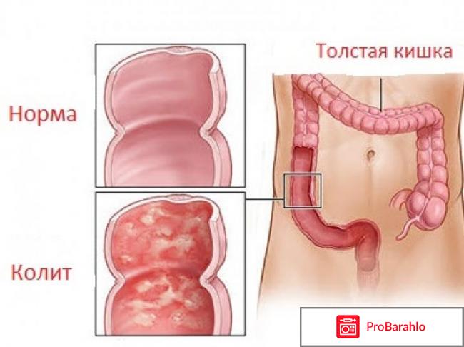 Чем опасен язвенный колит кишечника отрицательные отзывы