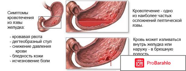 Симптомы язвенного кровотечения отрицательные отзывы