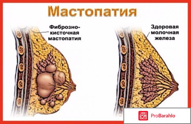 Huaxin Breast Plaster пластырь от мастопатии: цена отрицательные отзывы