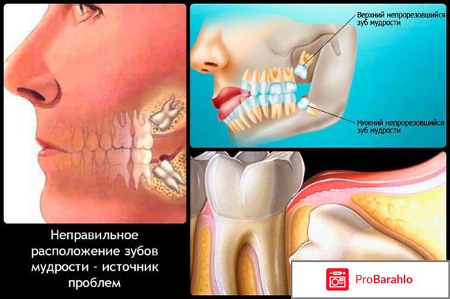 Зуб мудрости удалить 