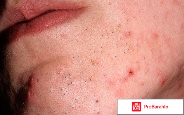 Клензит-с отзывы 