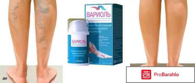 Вариоль - пенка от варикоза отзывы владельцев