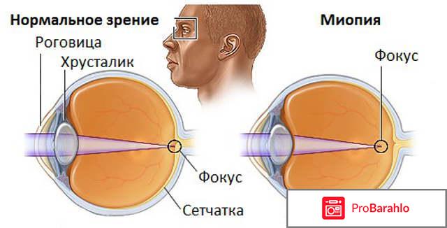 Миопия отрицательные отзывы