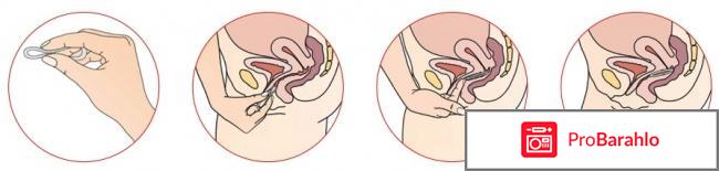 Новаринг кольцо отзывы женщин реальные отзывы