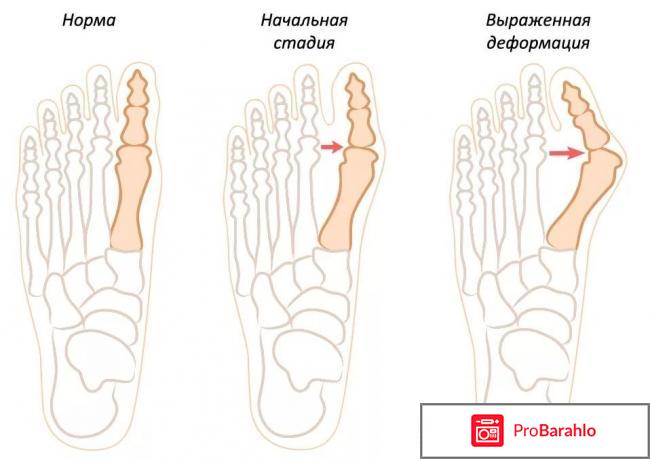 Шишка стоп отзывы отрицательные отрицательные отзывы