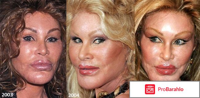 Диспорт фото до и после фото