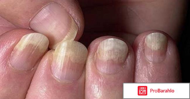 Деакура реальные отзывы