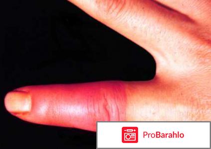 Вишневская мазь отрицательные отзывы