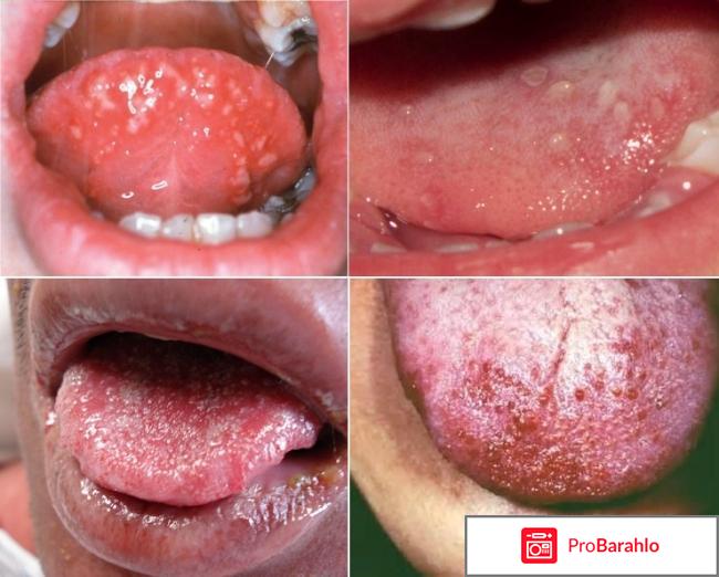 Пятна на языке у взрослых и детей, причины 