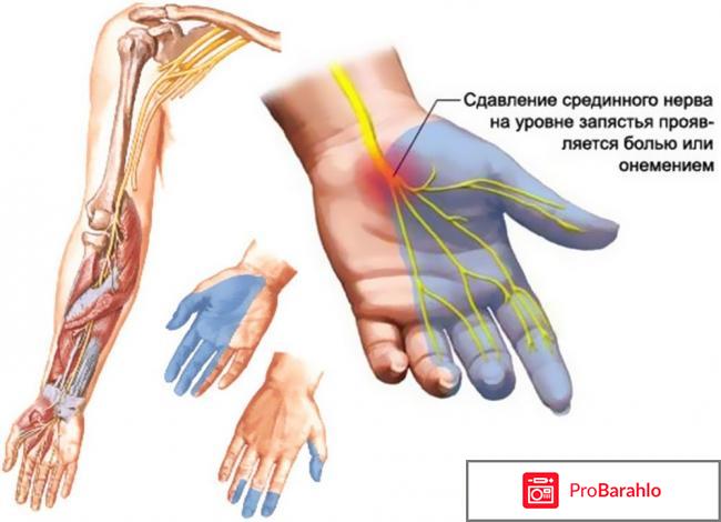 Немеют пальцы рук отрицательные отзывы