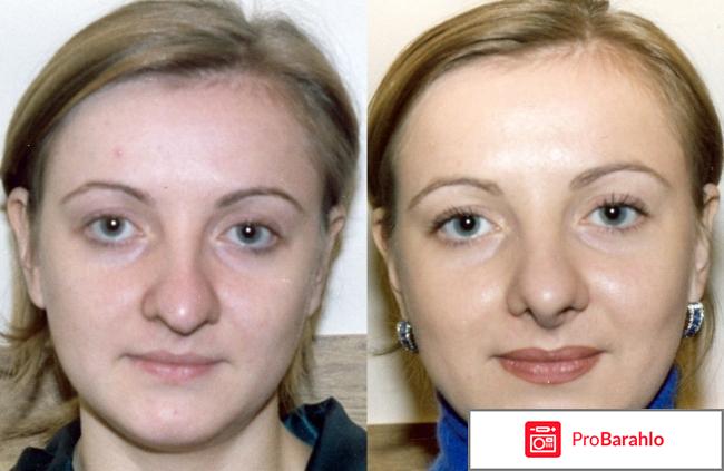 Ринопластика носа 