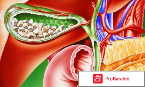 Холецистит симптомы отрицательные отзывы