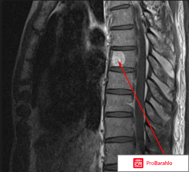 Гемангиома позвоночника к какому врачу обратиться отрицательные отзывы