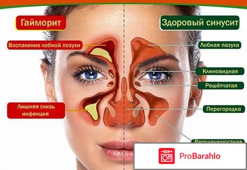 Антибиотики при гайморите 