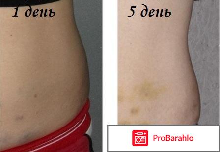 Уколы в живот для похудения отзывы обман