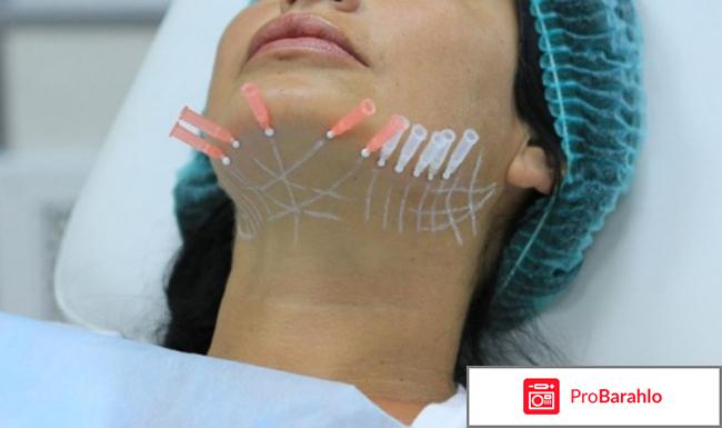 Мезонити отзывы негативные фото обман