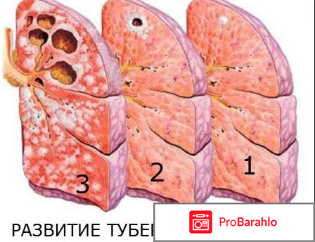 Бцж реальные отзывы