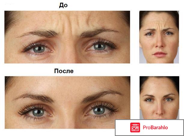 Диспорт фото до и после фото