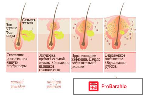 Либридерм сарацин от прыщей 