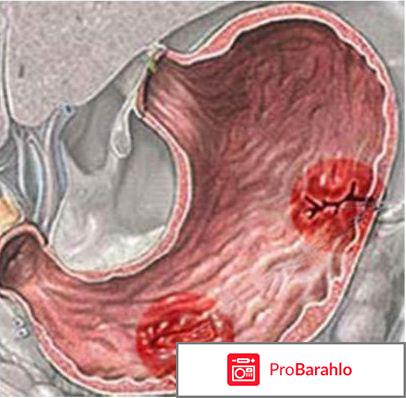 Лечение язвы желудка обман