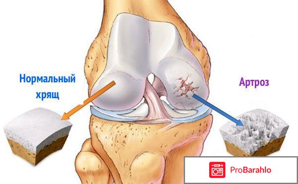 Остеон реальные отзывы