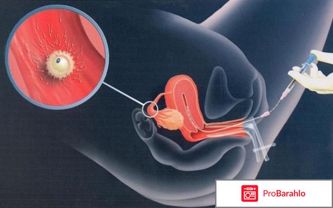 Инсеминация отзывы 