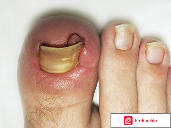 Вросший ноготь на ноге 