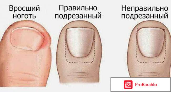 Вросшие ногти на ногах отрицательные отзывы