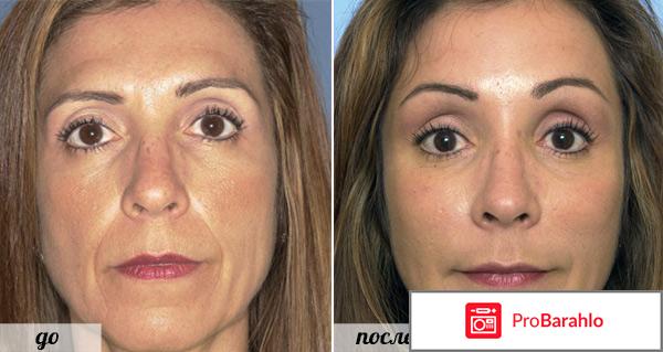 Bioretin отрицательные отзывы