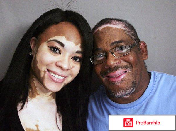 Лечение витилиго отзывы вылечившихся отрицательные отзывы