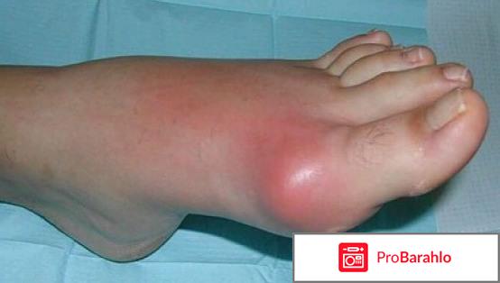 Препараты выводящие мочевую кислоту из организма 