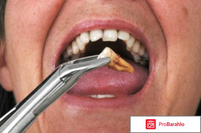 Мудрый зуб удаление 