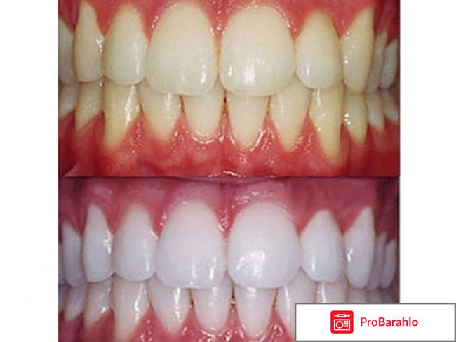 Фотоотбеливание зубов отрицательные отзывы