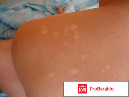 На спине появились белые пятна что это и как лечить обман