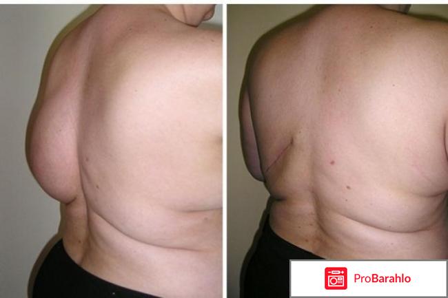 Удаление липомы отзывы обман