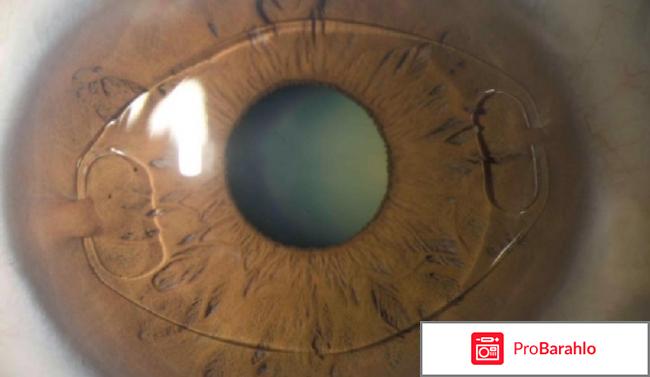 Искусственный хрусталик какой лучше отзывы цены 