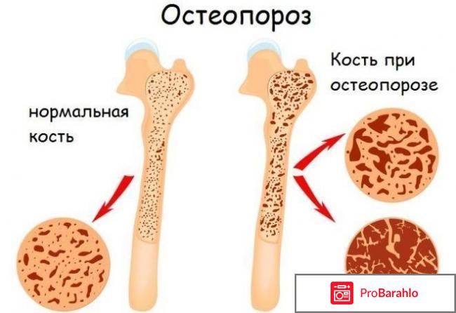 Пролиа отзывы врачей 