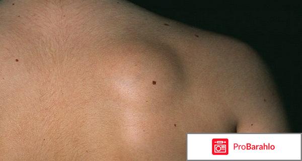 Атерома лечение в домашних условиях отзывы 