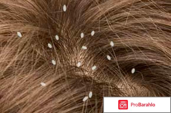 Как вывести вшей в домашних условиях у детей? 