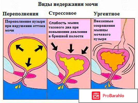 Недержание мочи у женщин лечение отзывы обман