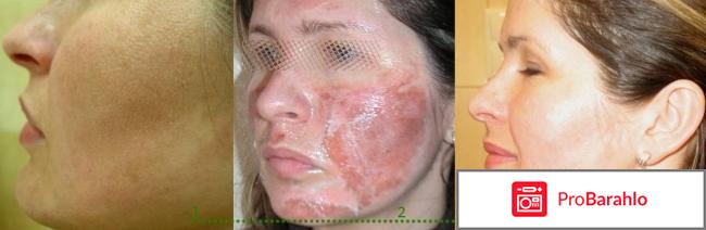 Срединный пилинг отрицательные отзывы